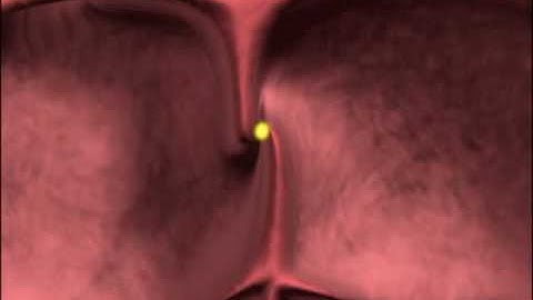 PFO Stroke Animation