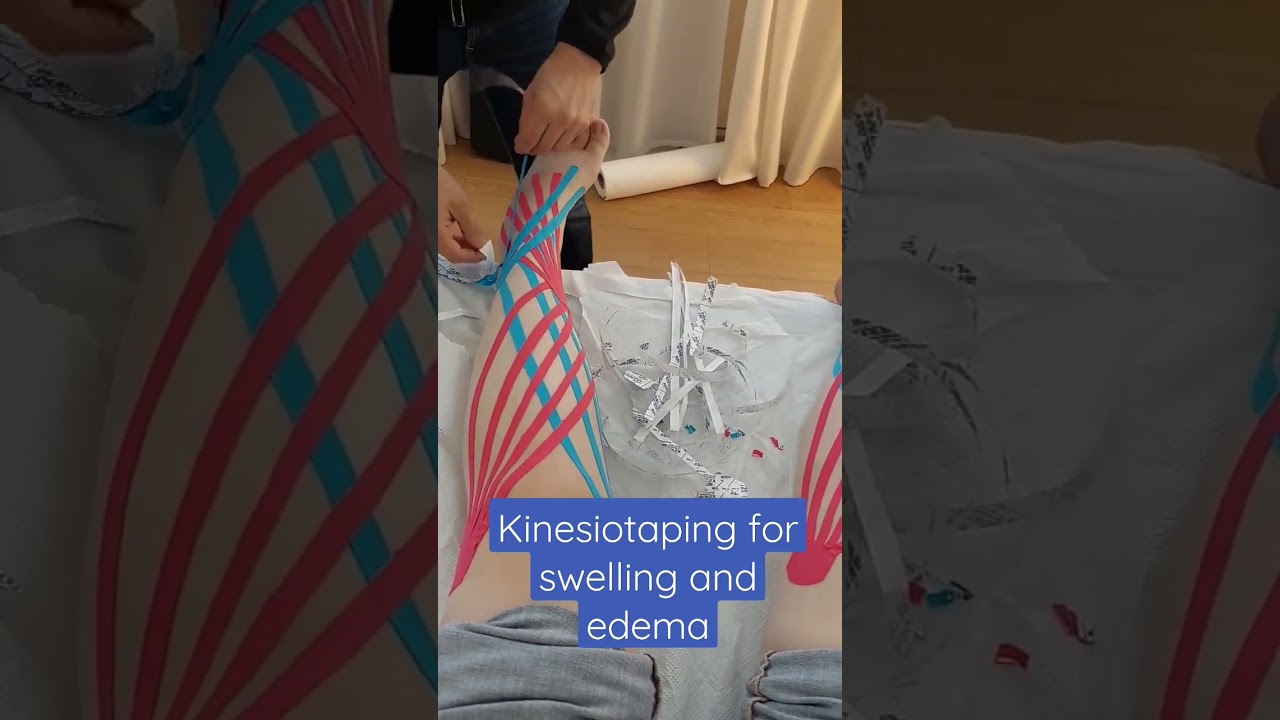 Kinesiotaping for swelling and edema