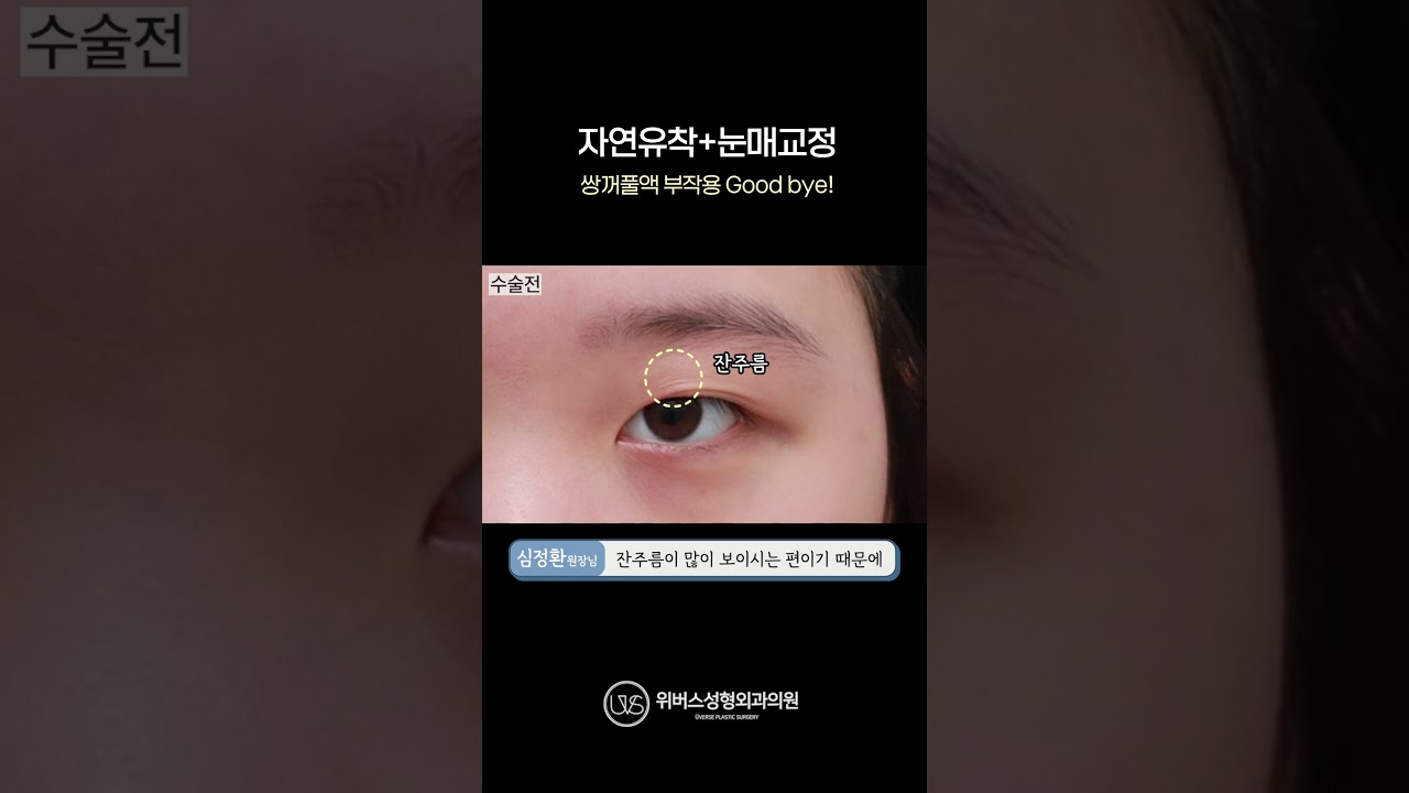 [Вивэрс Гоо сайхны мэс заслын эмнэлэг] ⭐Байгалийн аргаар давхрага үүсгэх + Нүдний хэлбэр засах⭐