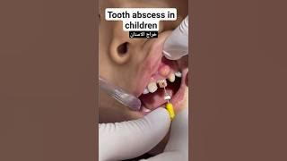 خراج الاسنان عند الأطفال ||Tooth abscess in children||علاج خراج الاسنان تحت الضرس