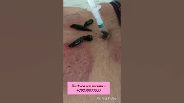 Пиявки гирудотерапия от боли в пояснице, грыже Шлук агар пушт дард мекунад. Хиджама дар Москва.