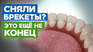 видео: Что такое ретейнеры и зачем они нужны? Установка и ношение ретейнеров после ортодонтического лечения картинка: Что такое ретейнеры и зачем они нужны? Установка и ношение ретейнеров после ортодонтического лечения