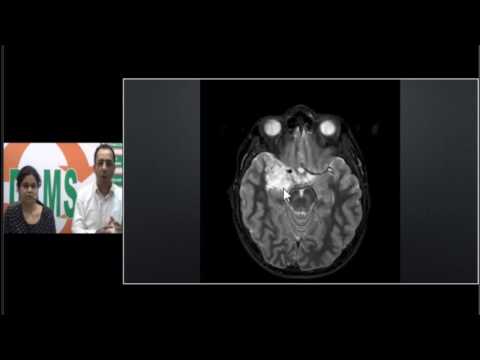 #DNET #radiopath Series #Dysembryoblastic #neuroepithelial tumour #dams #integrated #MedEd