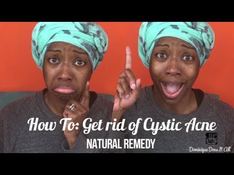 How To: Get rid of Cystic Acne- Natural Remedy - YouTube