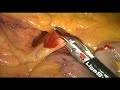 Intraoperative complications in laparoscopic colorectal surgery and how to avoid them