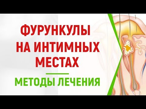 Чири на интимных местах лечение в домашних условиях