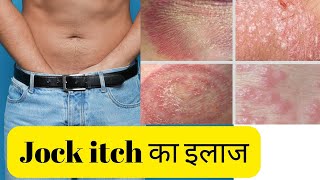 Jock itch home remedies | Jock itch treatment at home | Jock itch cream for private parts