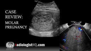 Case Review: Ultrasound of Complete Molar Pregnancy