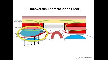 TTP Block (Transversus Thoracic Plane Block (TTP block) for of the anterior chest): Definition