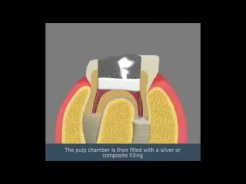 فيديو: كيف يتم بضع اللب على الأسنان الدائمة؟