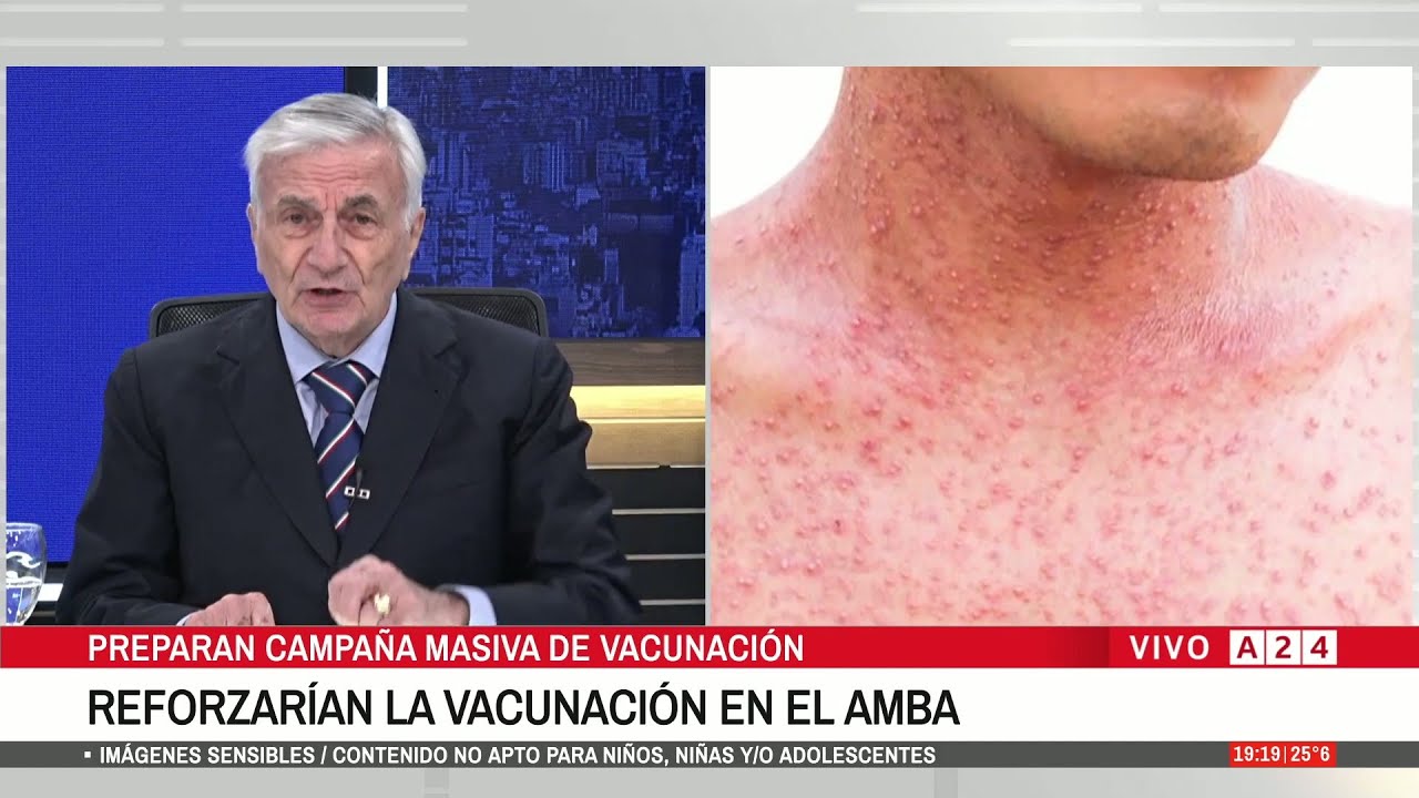 Preocupan los casos de sarampión en Argentina y refuerzan la vacunación: a quiénes alcanza