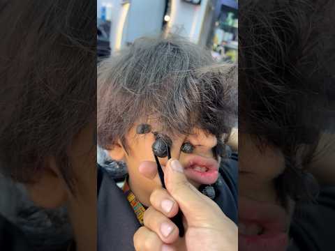 ازالة الحباية المتسلطنة م الخد       