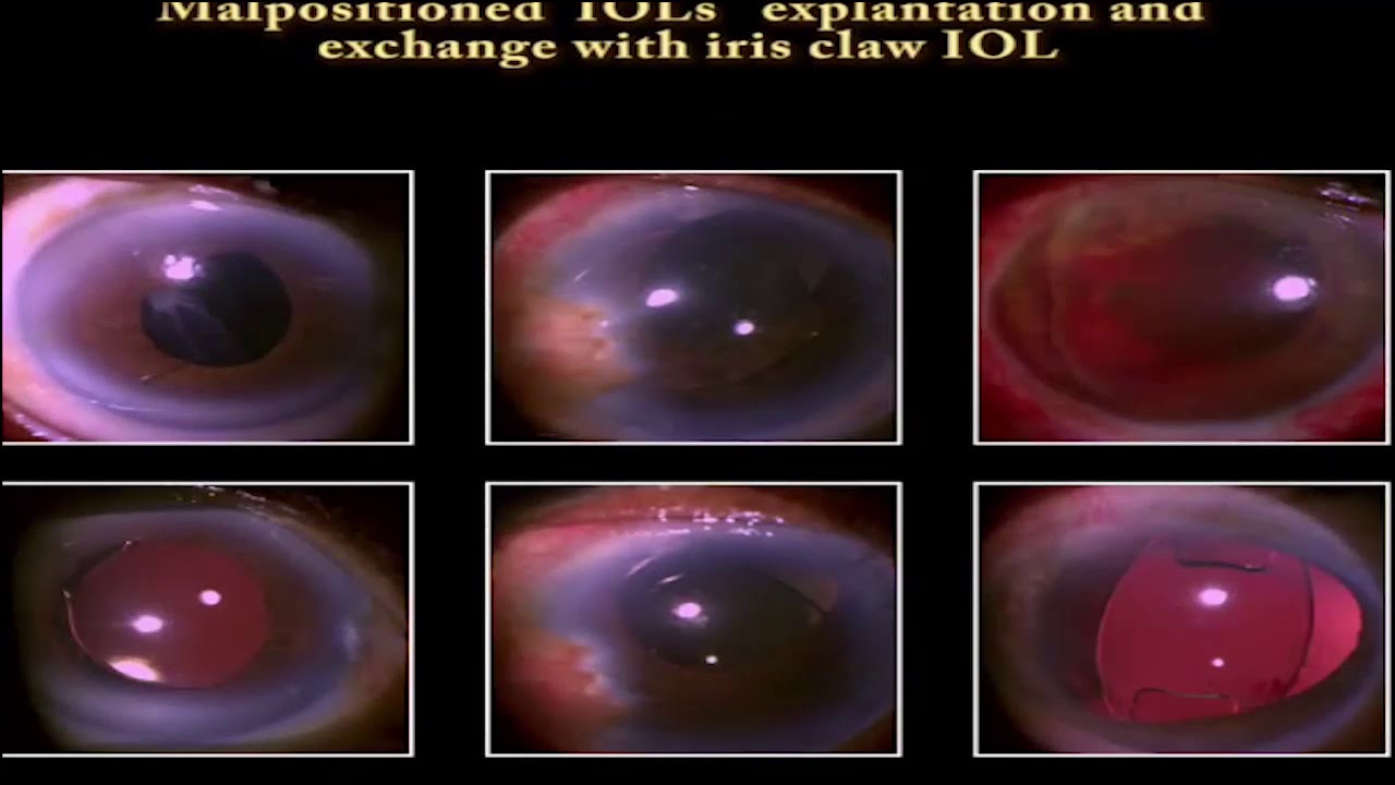Small Pupil Cataract Surgery Made Simple Using Apx Pupil Expanding