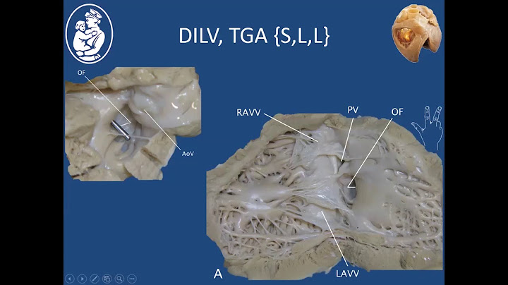 Double inlet left ventricle with transposition of the great arteries