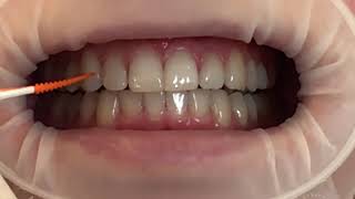 Dr Stil- Wie putze ich meine Zähne mit dem Retainer