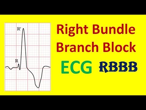 right-bundle-branch-block,-rbbb-on-ecg