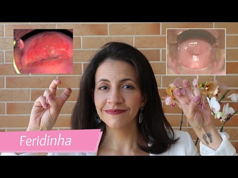 Vídeo: >> Geladura (Geladura) - Tratamento De Geladura Com Remédios E Métodos Populares