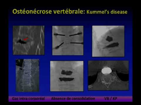 Vidéo: Contusion Vertébrale: Symptômes, Traitement, Conséquences