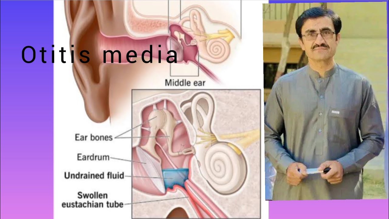 Otitis media (middle ear infection)UrduHindi YouTube