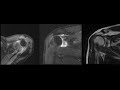 Подробный анализ МРТ плечевого сустава