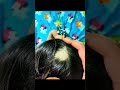 Alopecia Areata / Dr. Sanchika Gupta 👩‍⚕️