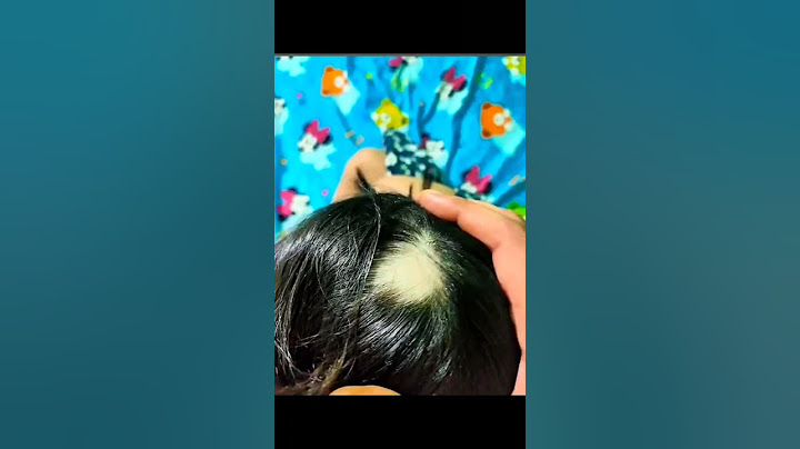 Alopecia Areata / Dr. Sanchika Gupta 👩‍⚕️