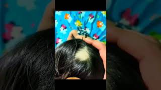 Alopecia Areata / Dr. Sanchika Gupta 👩‍⚕️