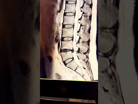 معلومة مهمة لايتم أخذ القرار العلاجي فقط من خلال صورة الرنين المغناطيسي علاج الديسك آلام الظهر