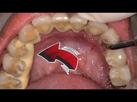 Video: Cara Memulihkan Gigi: Metode Efektif Dan Manfaatnya