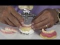 Good fit® - Instant Denture Setups - Expedited Denture Systems