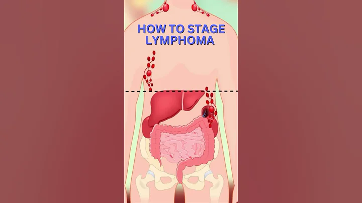 What is LYMPHOMA & How to Stage it!