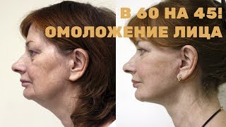 Омоложение лица – в 60 выглядеть на 45! Омоложение лица – в 60 выглядеть на 45!