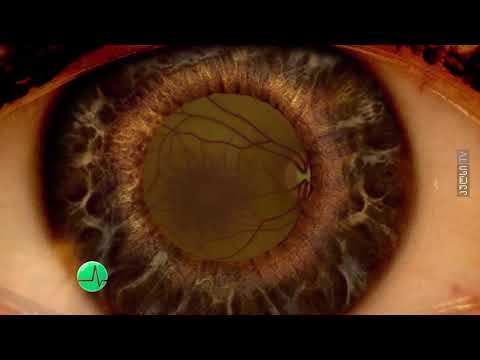 გლაუკომა