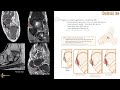 Tutoriel imosteo 26  physiopathologie et smiologie irm des lsions du spring ligament