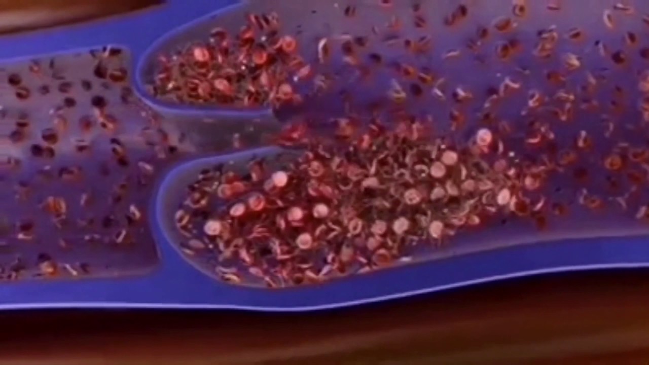 Тромбоэмболия