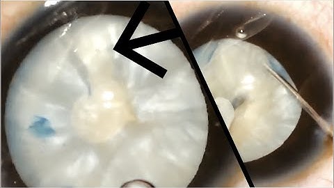 The  Capsulorrhexis extension to the periphery in an intumescent cataract:   How to proceed further.