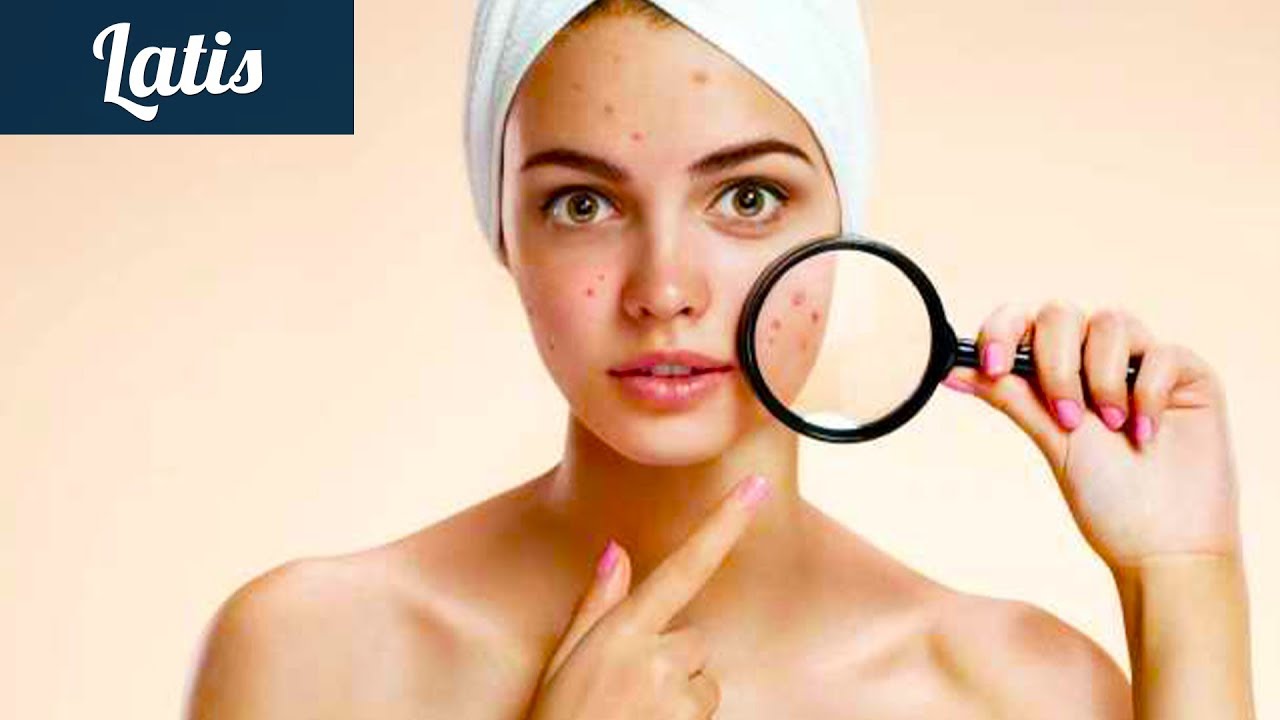 Акне и прыщи? - Готовим лосьон и избавляемся! - YouTube