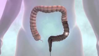 Testing for Bowel Cancer | Cancer Research UK