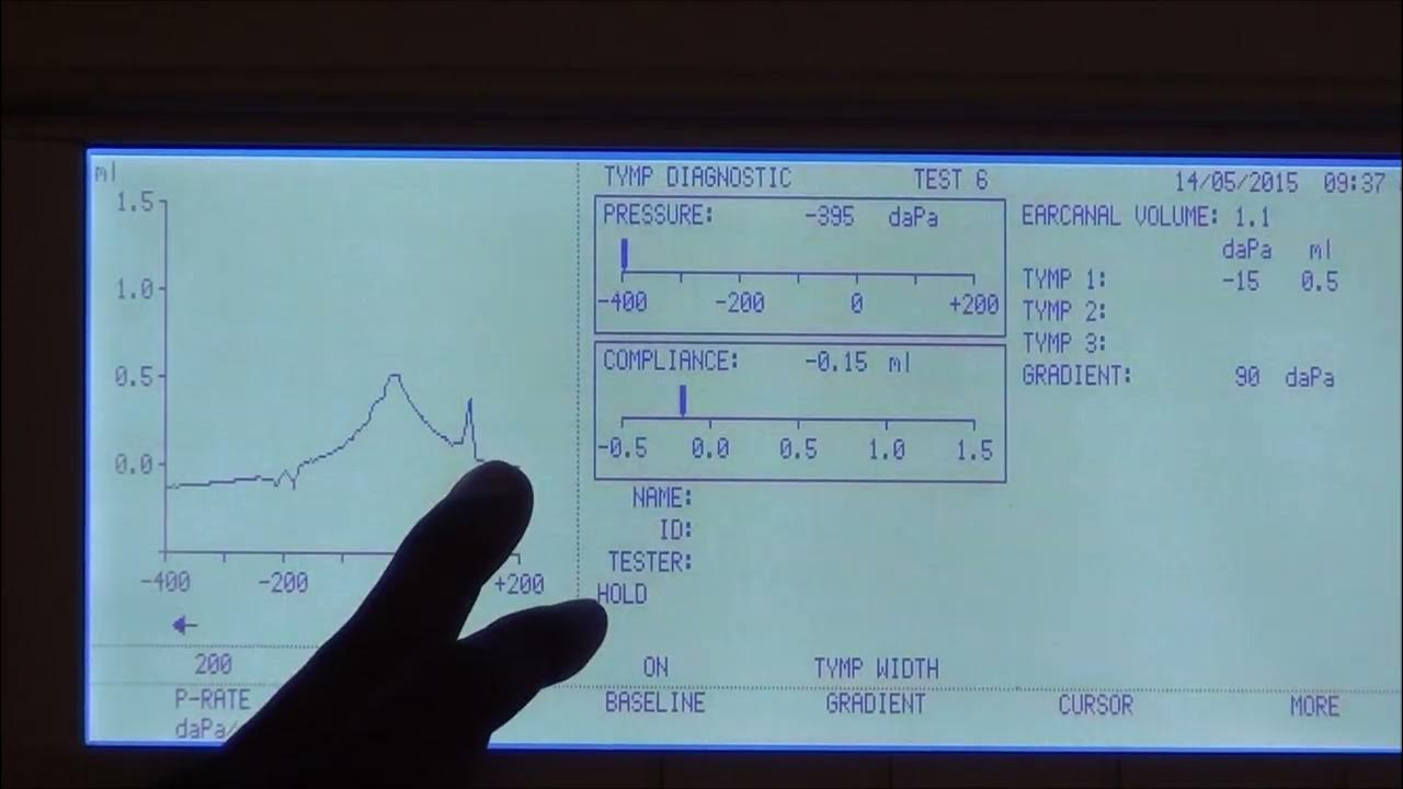 Tympanometry Part1 YouTube