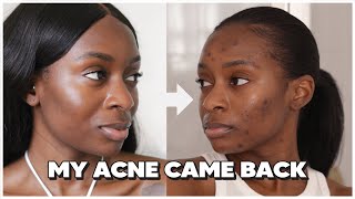 One Year After Accutane, My Acne Is Back | what caused it, new skincare regimen, second course?