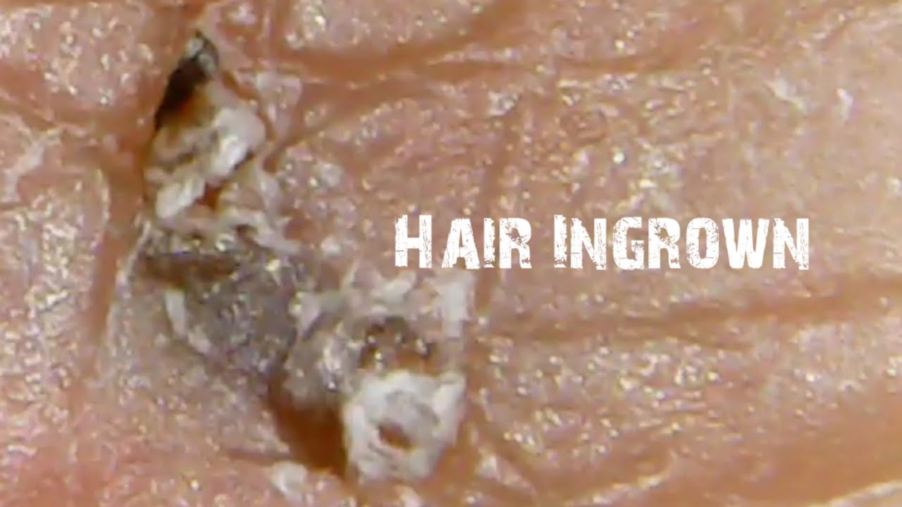Short video|Hair Ingrown Removal| Long Hair - YouTube