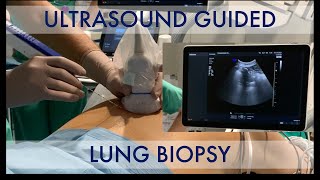 US-guided lung biopsy screenshot 5