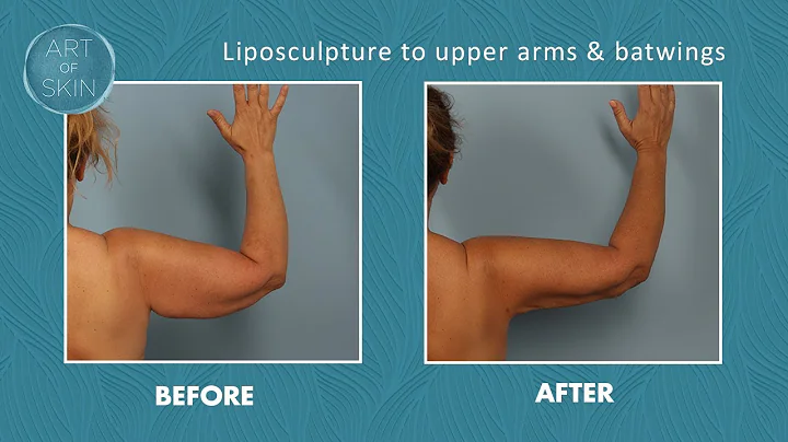 Laser liposuction of upper arms and batwings