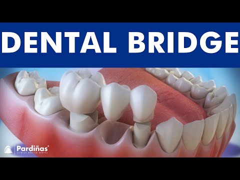 Dental Bridge Treatment