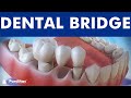 Dental bridge  fixed dental replacement 