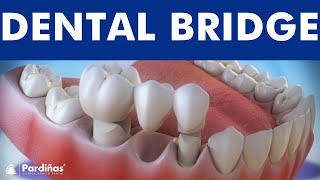 Dental bridge - Fixed dental replacement ©
