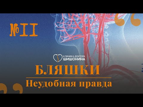 Бляшки и как с ними жить: рассказывает сосудистый хирург в новом выпуске «Хорошей медицины» 💊