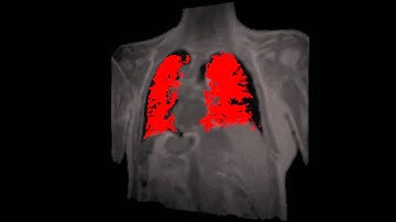 Dynamic contrast enhanced MRI of the lungs