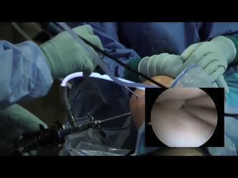 Arthroscopic Knee Surgery Meniscus Tear