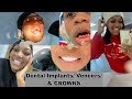 WE HAD OUR TEETH DONE IN TURKEY FOR CHEAP! | THE COST & OUR EXPERIENCE IMPLANTS, CROWNS, & VENEERS